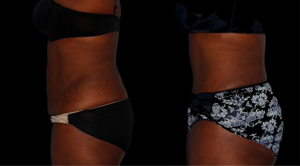 Before and After Photos Chevy Chase, MD Ikon Plastic Surgery and Medical Aesthetics Dr. James Economides
