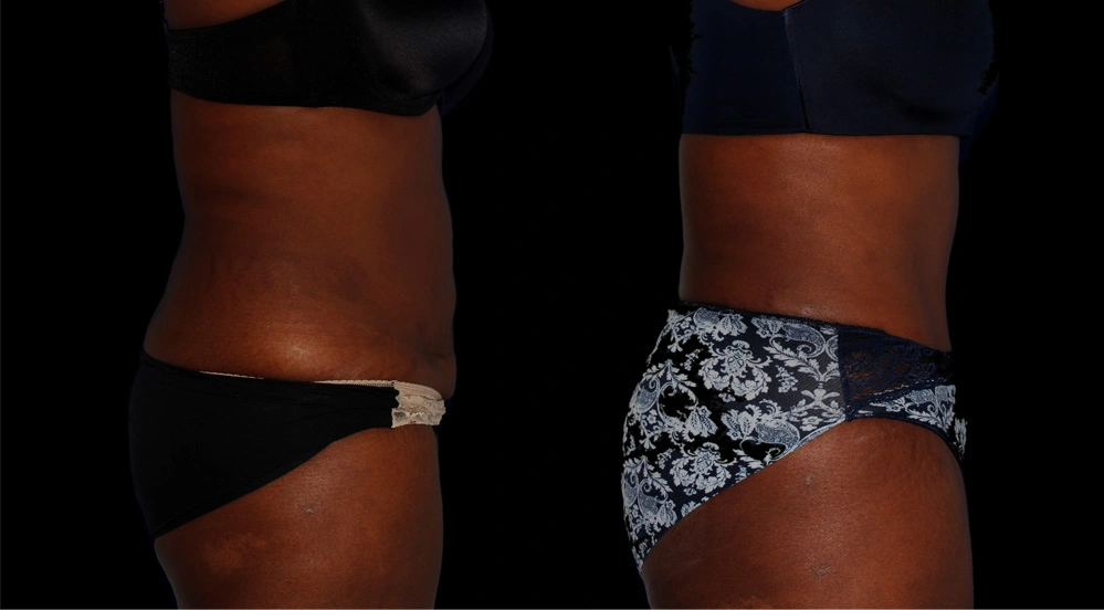 Before and After Photos Chevy Chase, MD Ikon Plastic Surgery and Medical Aesthetics Dr. James Economides