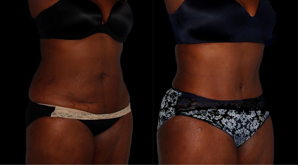 Before and After Photos Chevy Chase, MD Ikon Plastic Surgery and Medical Aesthetics Dr. James Economides