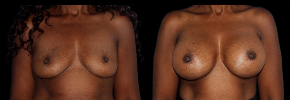 Before and After Photos Chevy Chase, MD Ikon Plastic Surgery and Medical Aesthetics Dr. James Economides