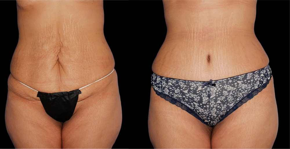 Before and After Photos Chevy Chase, MD Ikon Plastic Surgery and Medical Aesthetics Dr. James Economides
