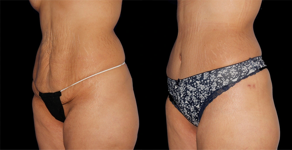 Before and After Photos Chevy Chase, MD Ikon Plastic Surgery and Medical Aesthetics Dr. James Economides