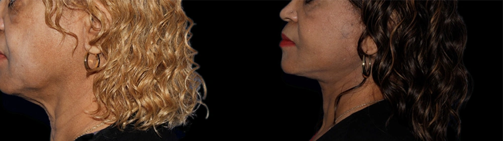 Before and After Photos Chevy Chase, MD Ikon Plastic Surgery and Medical Aesthetics Dr. James Economides