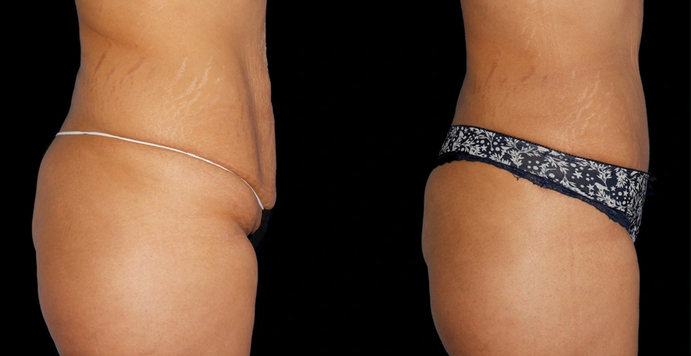 Before and After Photos Chevy Chase, MD Ikon Plastic Surgery and Medical Aesthetics Dr. James Economides