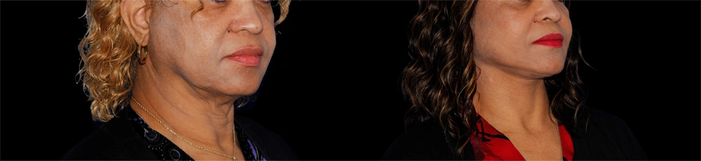 Before and After Photos Chevy Chase, MD Ikon Plastic Surgery and Medical Aesthetics Dr. James Economides