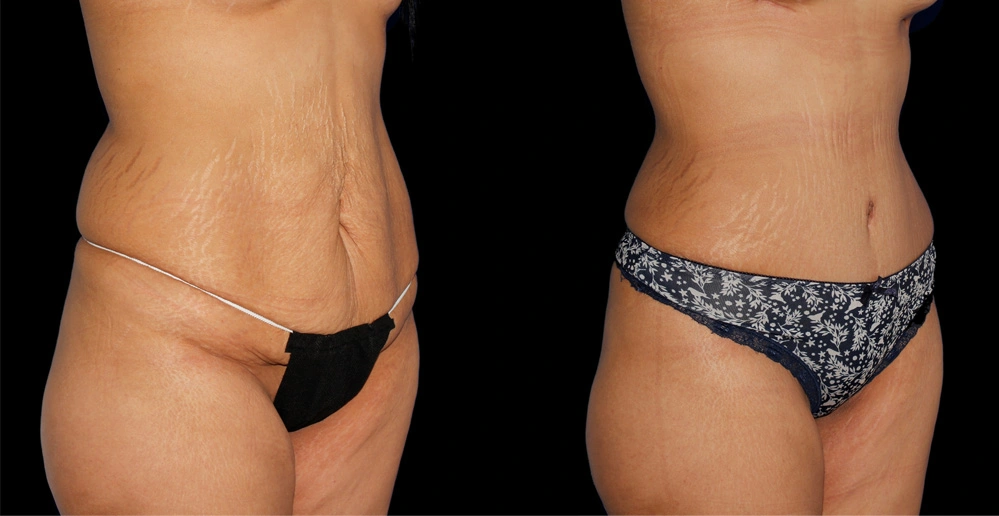 Before and After Photos Chevy Chase, MD Ikon Plastic Surgery and Medical Aesthetics Dr. James Economides