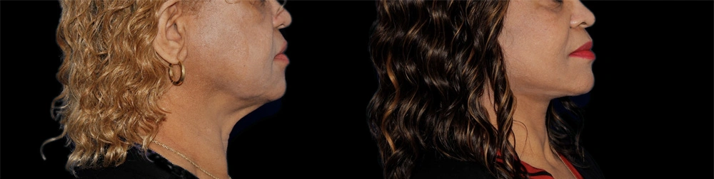 Before and After Photos Chevy Chase, MD Ikon Plastic Surgery and Medical Aesthetics Dr. James Economides