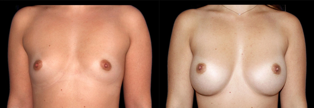 Before and After Photos Chevy Chase, MD Ikon Plastic Surgery and Medical Aesthetics Dr. James Economides