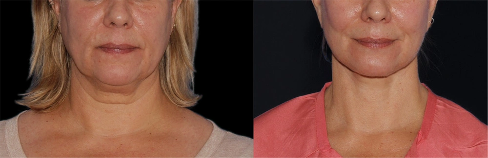 Before and After Photos Chevy Chase, MD Ikon Plastic Surgery and Medical Aesthetics Dr. James Economides