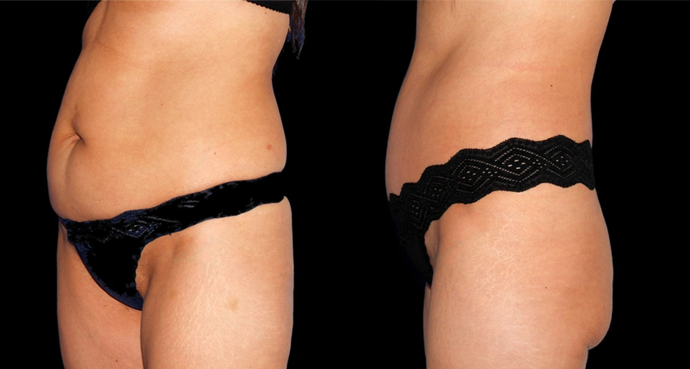 Before and After Photos Chevy Chase, MD Ikon Plastic Surgery and Medical Aesthetics Dr. James Economides
