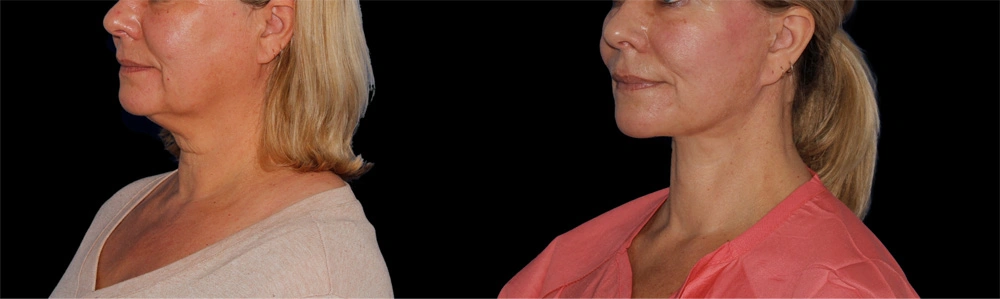Before and After Photos Chevy Chase, MD Ikon Plastic Surgery and Medical Aesthetics Dr. James Economides