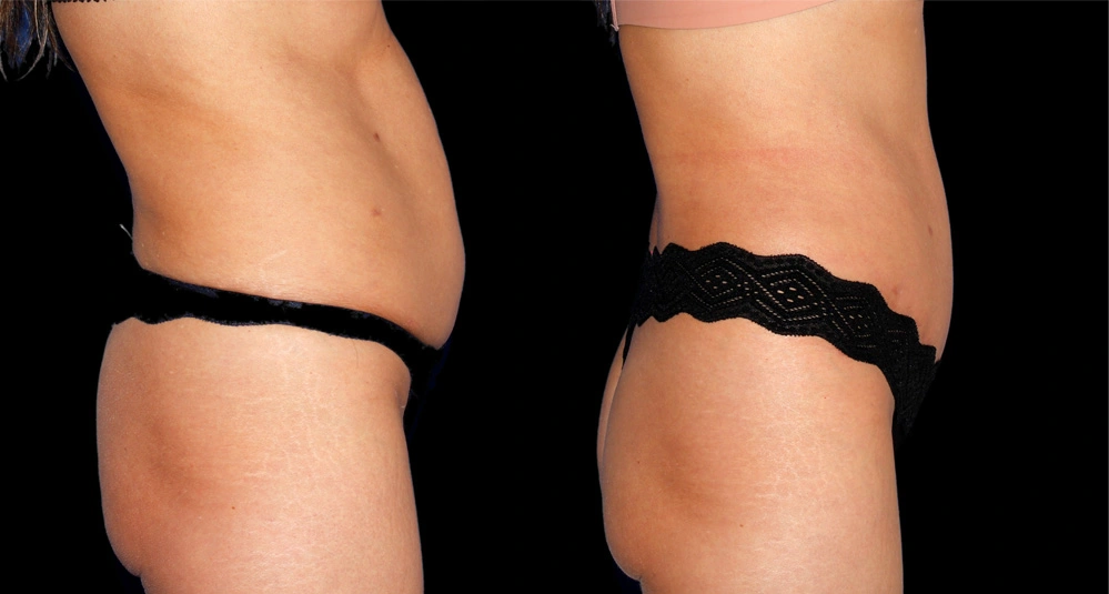 Before and After Photos Chevy Chase, MD Ikon Plastic Surgery and Medical Aesthetics Dr. James Economides