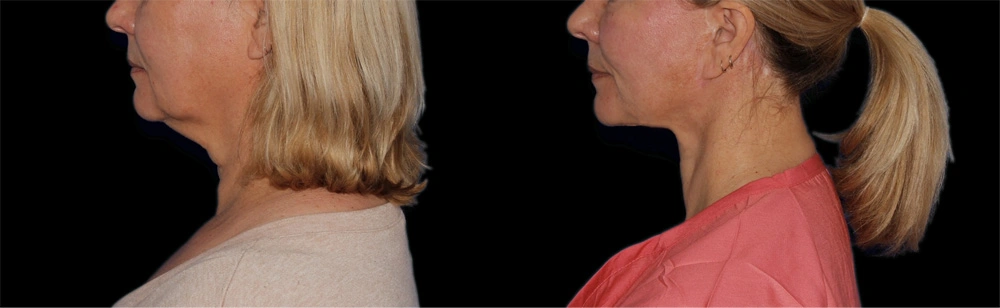 Before and After Photos Chevy Chase, MD Ikon Plastic Surgery and Medical Aesthetics Dr. James Economides