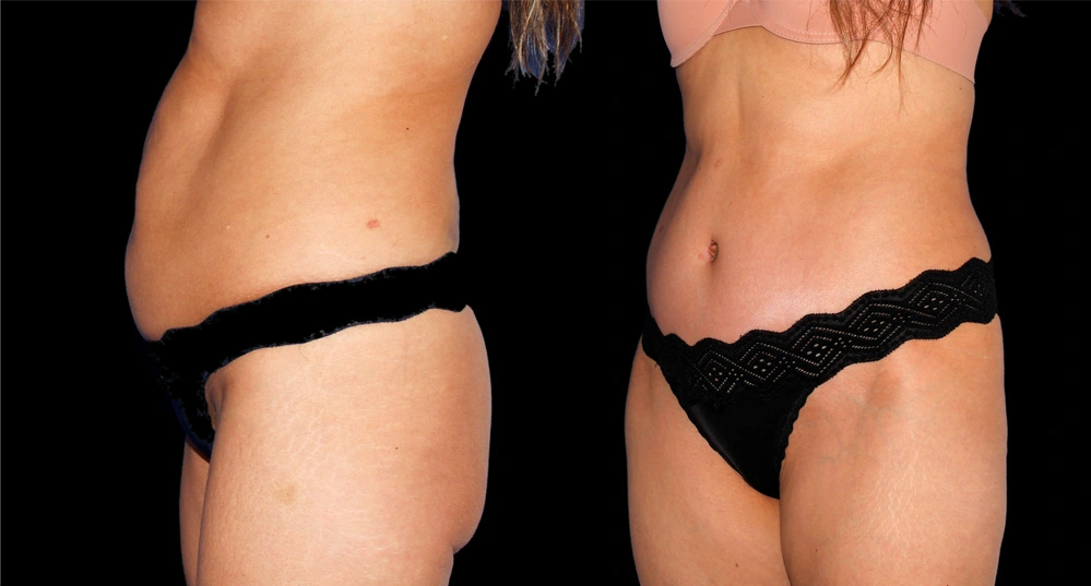 Before and After Photos Chevy Chase, MD Ikon Plastic Surgery and Medical Aesthetics Dr. James Economides