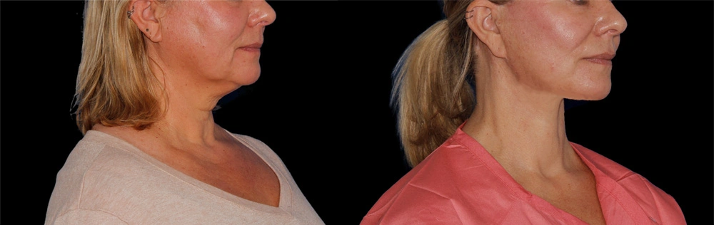 Before and After Photos Chevy Chase, MD Ikon Plastic Surgery and Medical Aesthetics Dr. James Economides