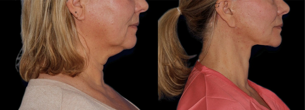 Before and After Photos Chevy Chase, MD Ikon Plastic Surgery and Medical Aesthetics Dr. James Economides