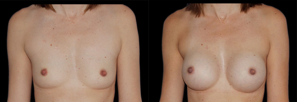 Before and After Photos Chevy Chase, MD Ikon Plastic Surgery and Medical Aesthetics Dr. James Economides