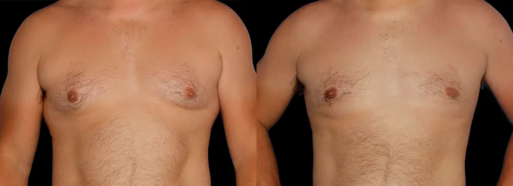 FD_gynecomastia_01