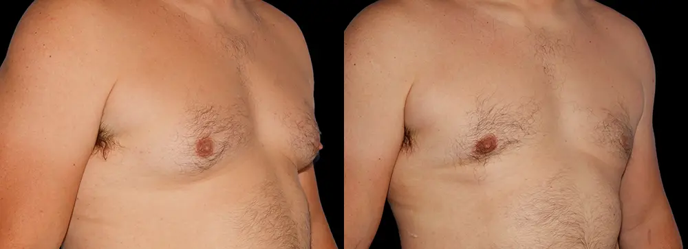 FD_gynecomastia_02