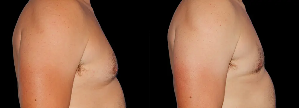 FD_gynecomastia_03