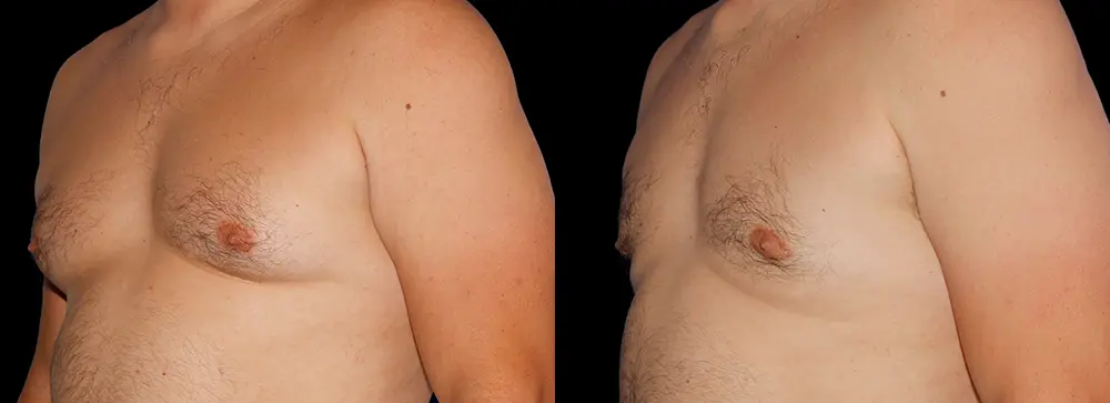 FD_gynecomastia_04