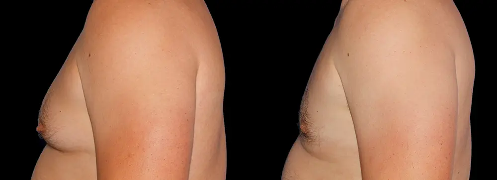 FD_gynecomastia_05