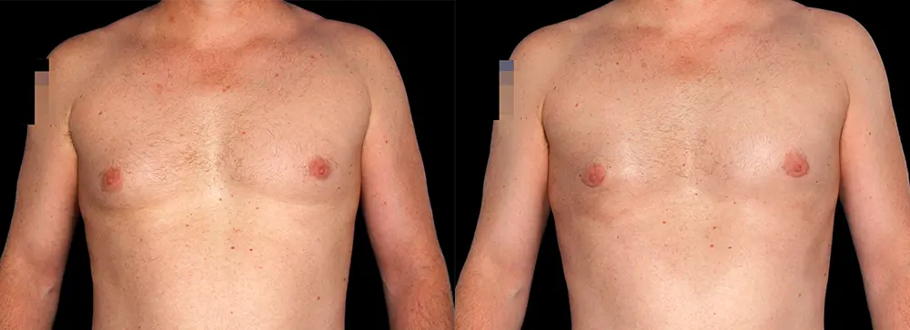 KC_gynecomastia_01