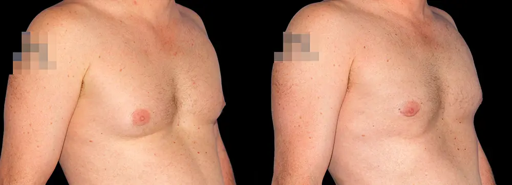 KC_gynecomastia_02