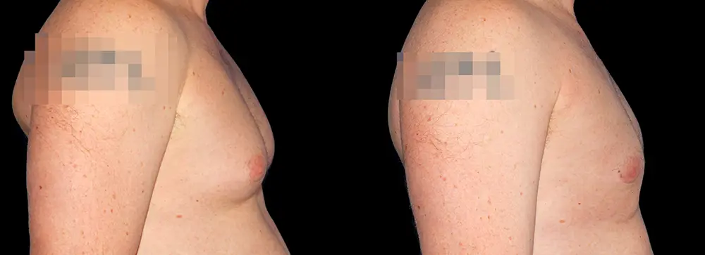 KC_gynecomastia_03