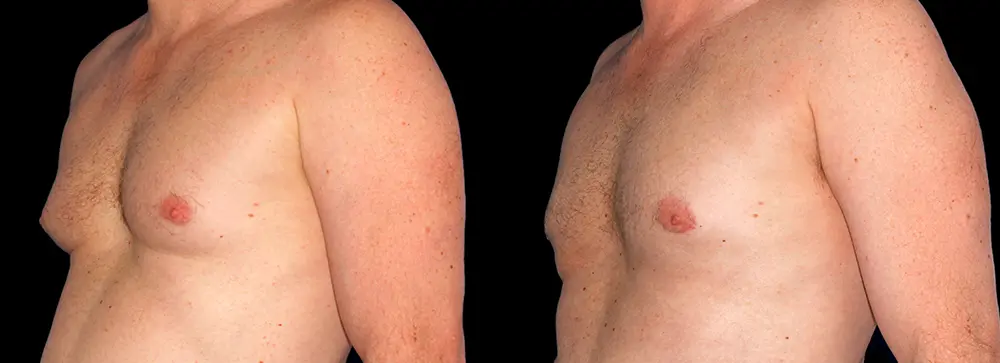 KC_gynecomastia_04