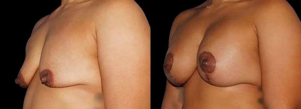 LS_augpexy_01