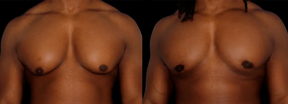 OD_gynecomastia_01