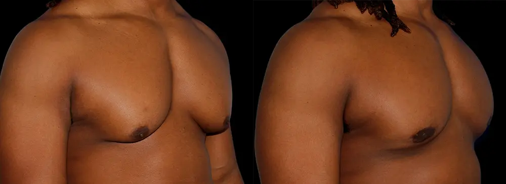 OD_gynecomastia_02