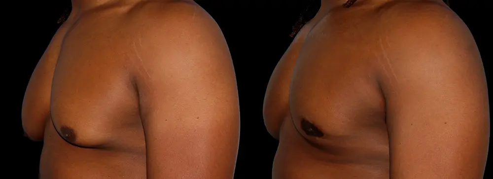 OD_gynecomastia_04