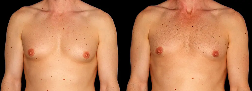 PA_gynecomastia_01