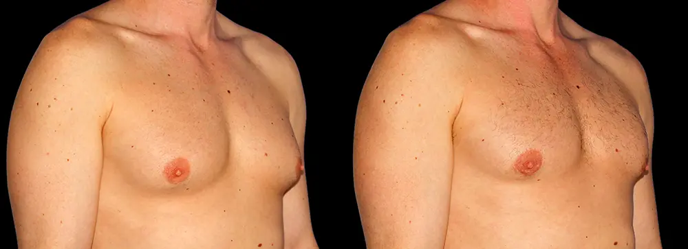PA_gynecomastia_02