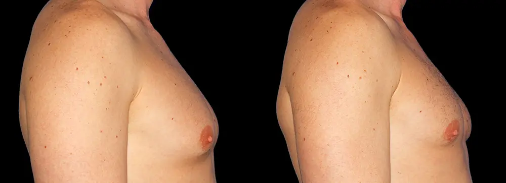 PA_gynecomastia_03
