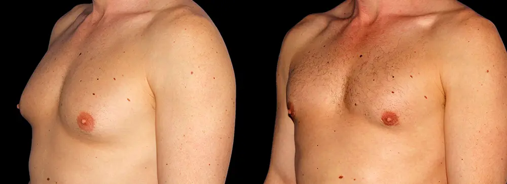 PA_gynecomastia_04