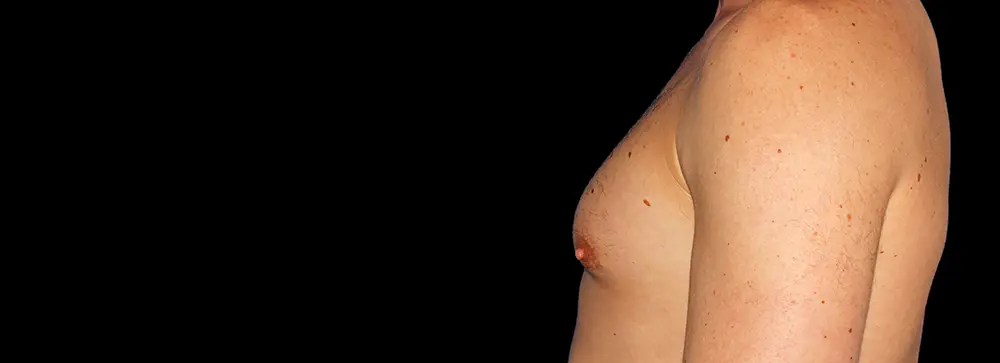 PA_gynecomastia_05