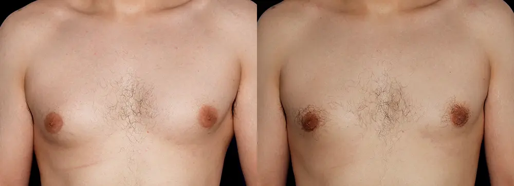 RR_gynecomastia_01