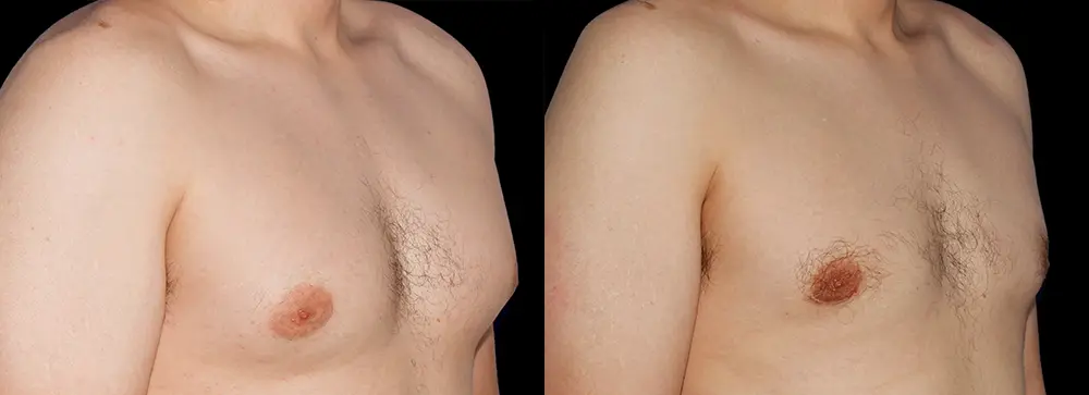 RR_gynecomastia_02