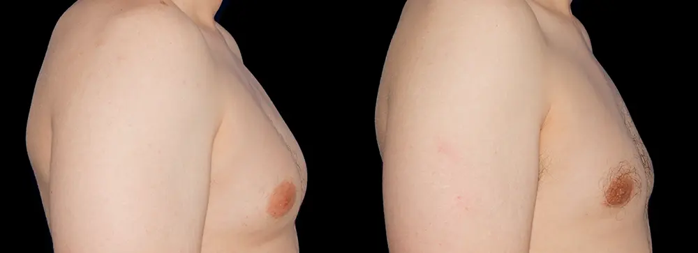 RR_gynecomastia_03