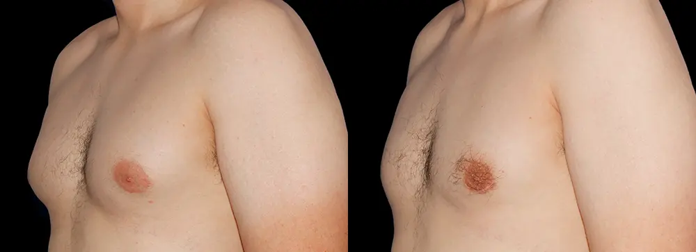 RR_gynecomastia_04