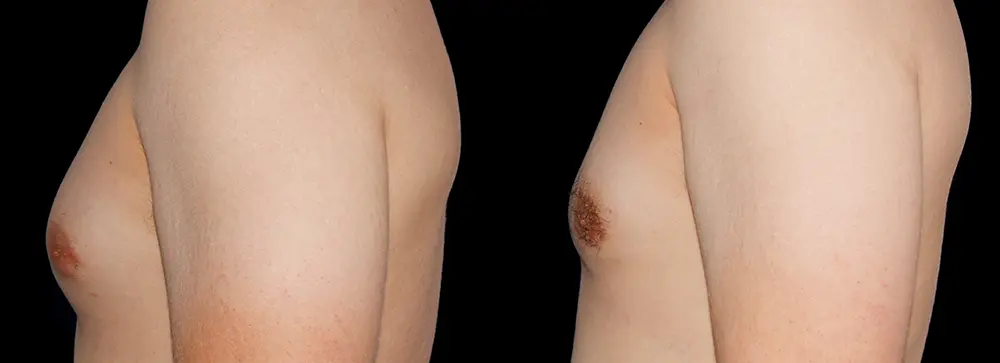 RR_gynecomastia_05