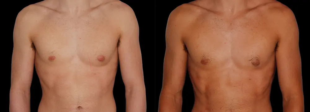 bm_gynecomastia_01