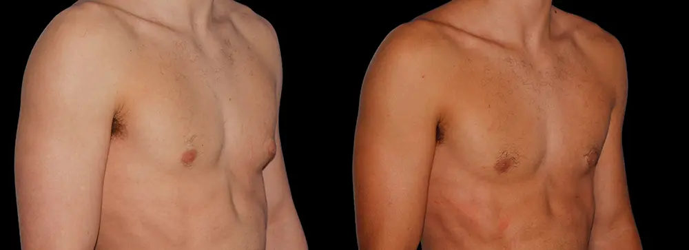 bm_gynecomastia_02