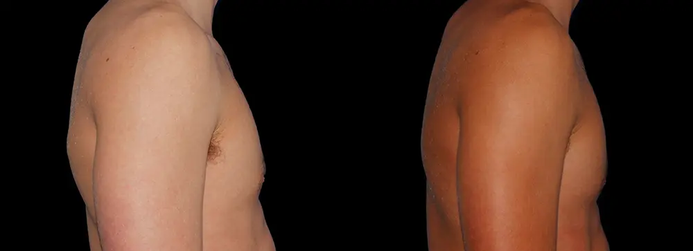 bm_gynecomastia_03