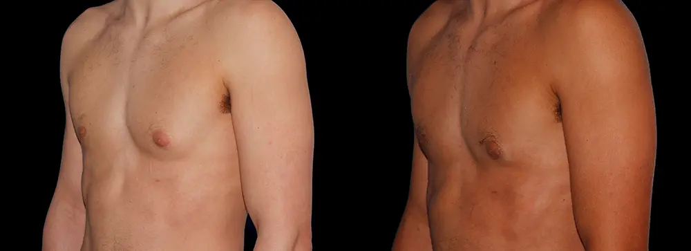 bm_gynecomastia_04