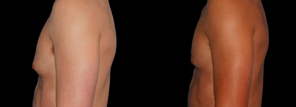 bm_gynecomastia_05