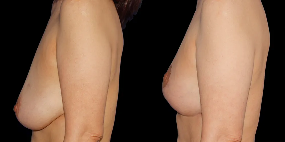 mastopexy-01_05